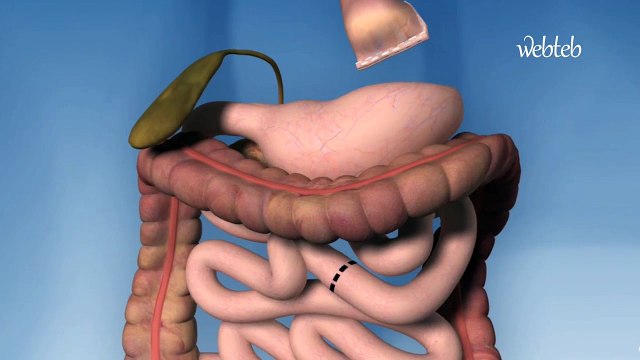 شاهدوا كيف تتم عملية تحويل مجرى المعدة