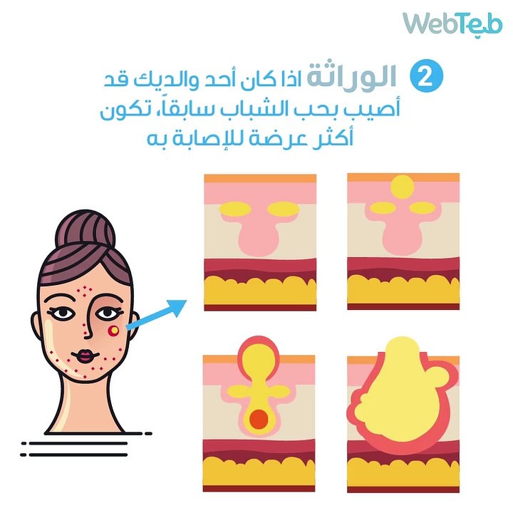 حب الشباب: أسبابه وطرق الوقاية!