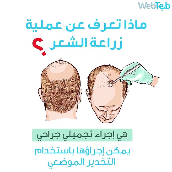 ماذا تعرف عن عملية زراعة الشعر؟