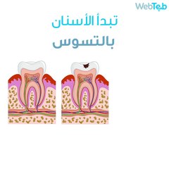 كيف تصبح الأسنان حساسة؟