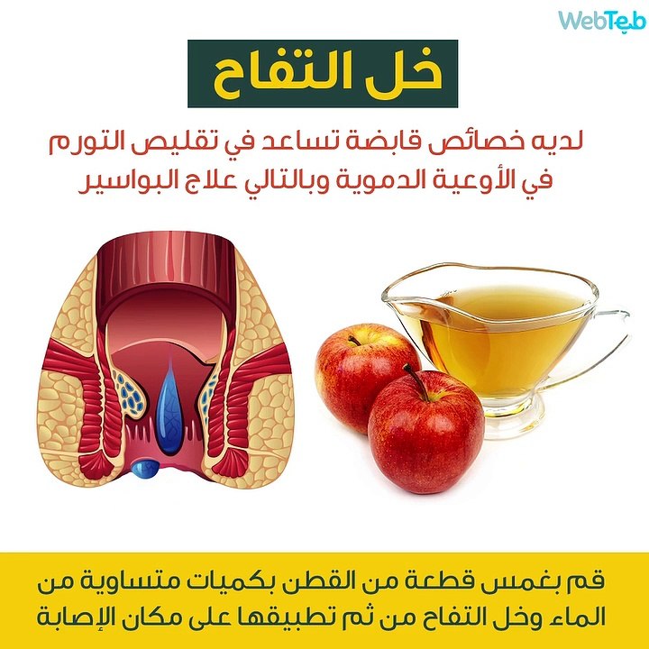 طرق فعالة وطبيعية لعلاج البواسير