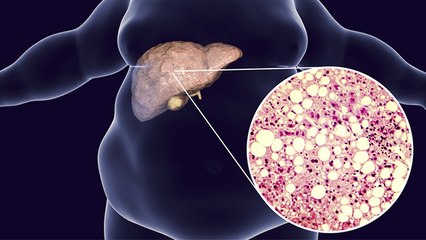 फैटी लीवर को वक्त रहते बनाएं स्वस्थ जानिए संकेत, लक्षण और कारण । Fatty Liver Disease । Boldsky