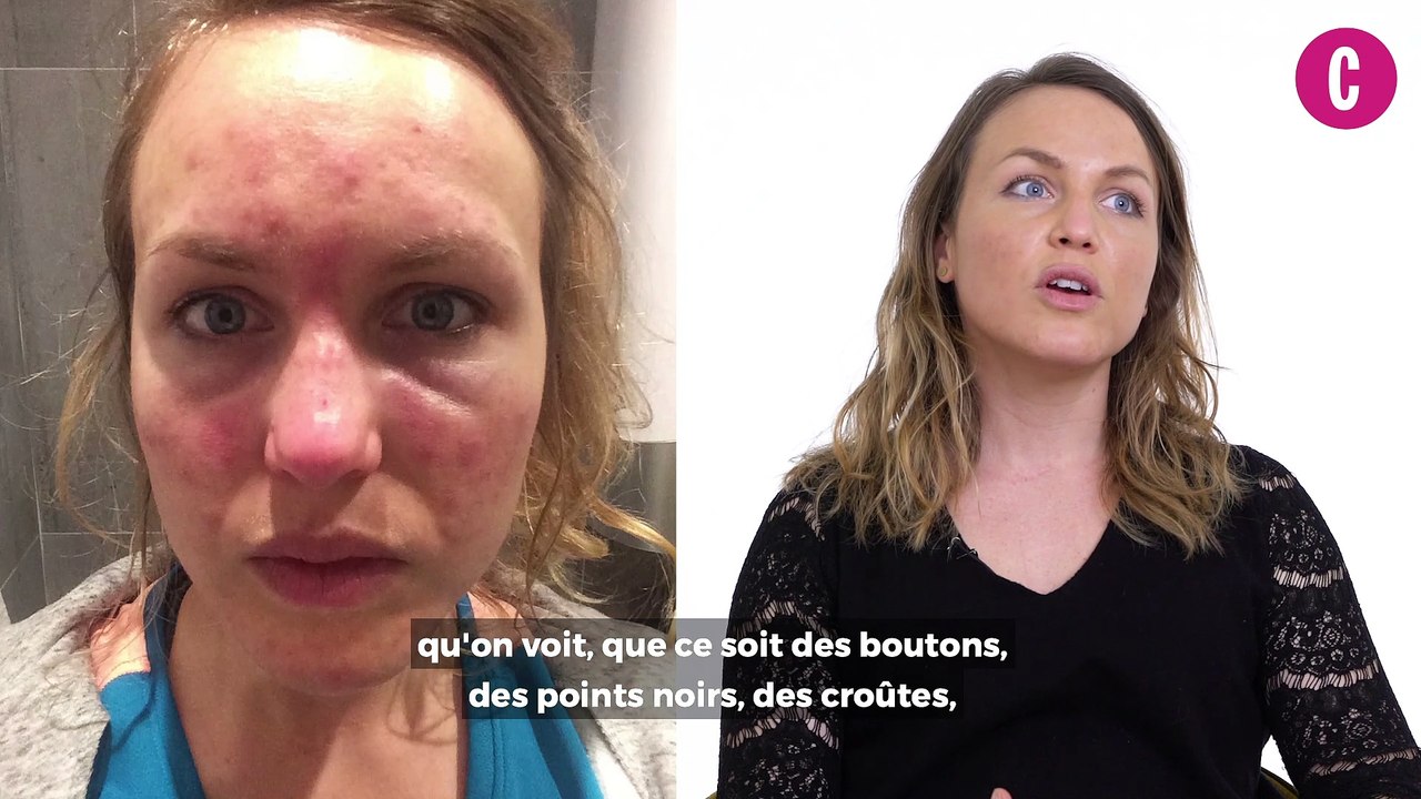 Camille nous parle de sa dermatillomanie, ce trouble anxieux méconnu