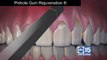 Pinhole Gum Rejuvenation: An easier fix for receding gums
