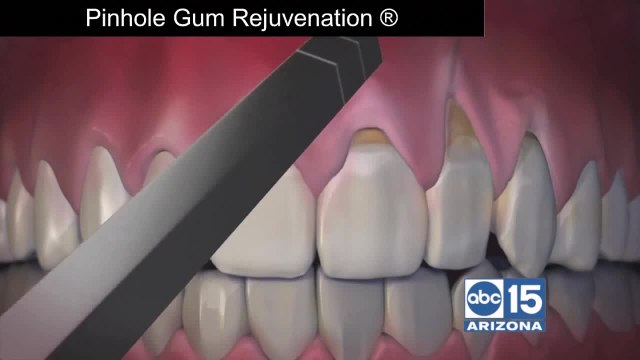 Pinhole Gum Rejuvenation: An easier fix for receding gums