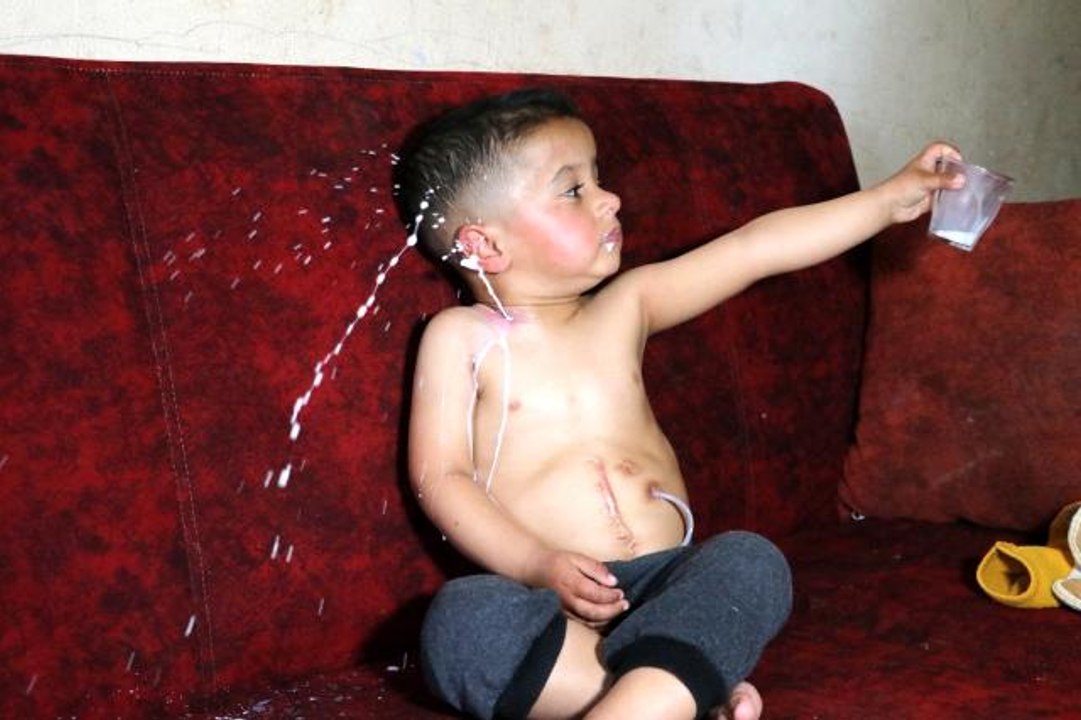 Yemek borusu olmayan Muhammed yardım bekliyor