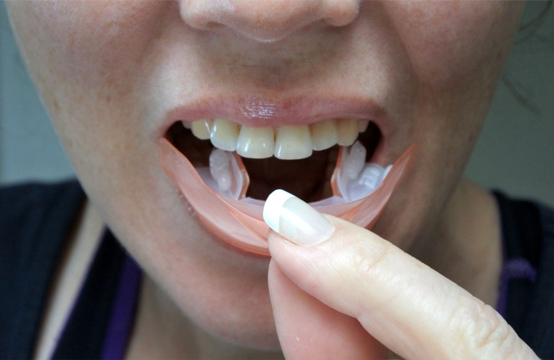 Man finally removes retainer after five years