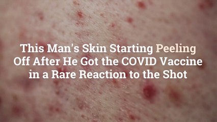 下载视频: This Man's Skin Starting Peeling Off After He Got the COVID Vaccine in a Rare Reaction to