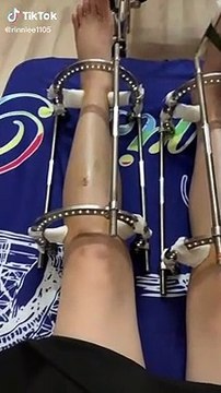 Cô gái kéo chân vì mơ ước cao thêm 7cm