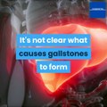 what-are-gallstones-and-their-causes