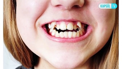 Süt dişlerini çektirmek zararlı mıdır? Ne zaman dökülür?