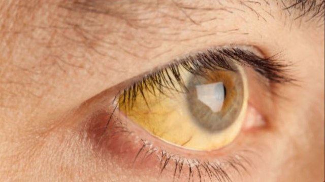 bd-a-que-se-debe-el-color-amarillo-050421