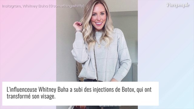 Une influenceuse transformée après des injections de Botox, le résultat est effrayant