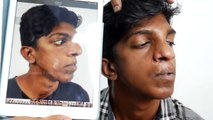 Cleft Rhinoplasty Before And After Results In India  - 2 Weeks Post Rhinoplasty Surgery