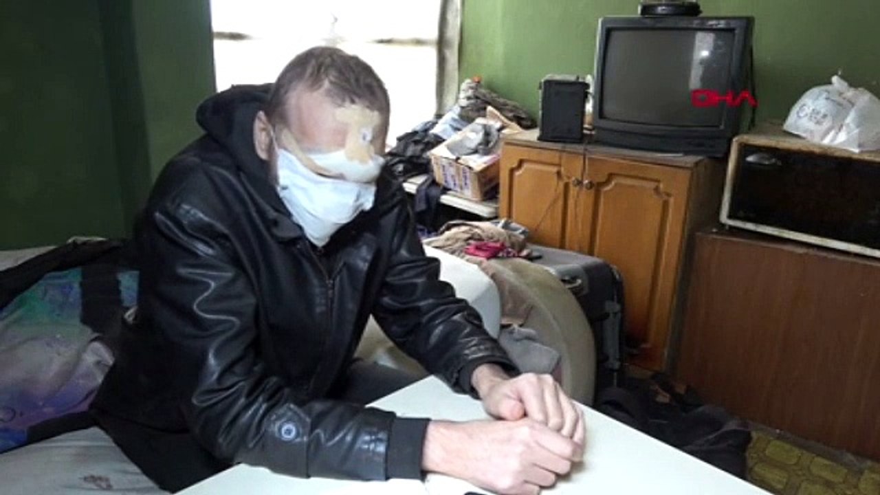 Burnunda çıkan siğil hayatını kabusa çevirdi