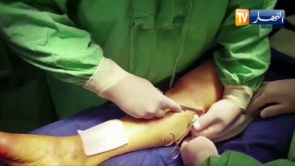 أسباب ظهور دوالي الساقين وسبل علاجها مع مختصين