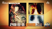 말기가 될 때까지 모르고 당한다? 흡연만큼 위험한 폐암 유발 요인은?!