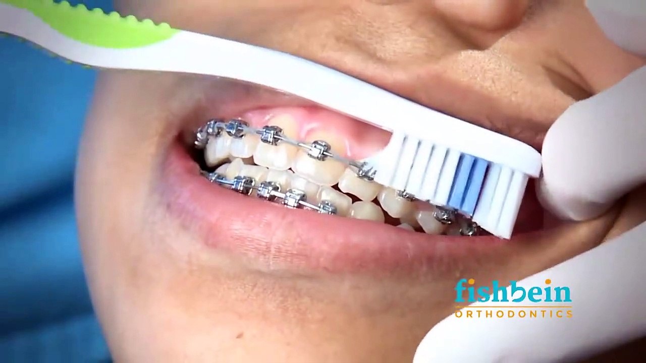 Orthodontic Home Care Instructions | Braces | Brushing