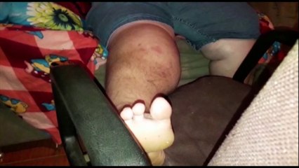 Homem que sofreu acidente há 4 meses precisa de ajuda para custear procedimento cirúrgico na perna