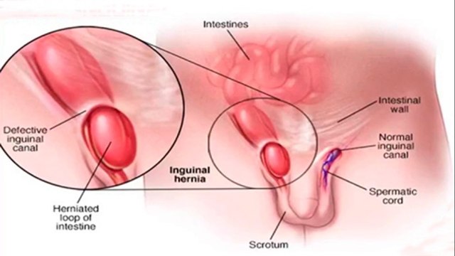 bd-que-son-y-como-se-tratan-las-hernias-inguinales-150421