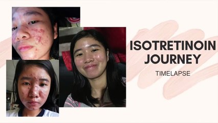 Before And After 6 Months On Isotretinoin | Time Lapse