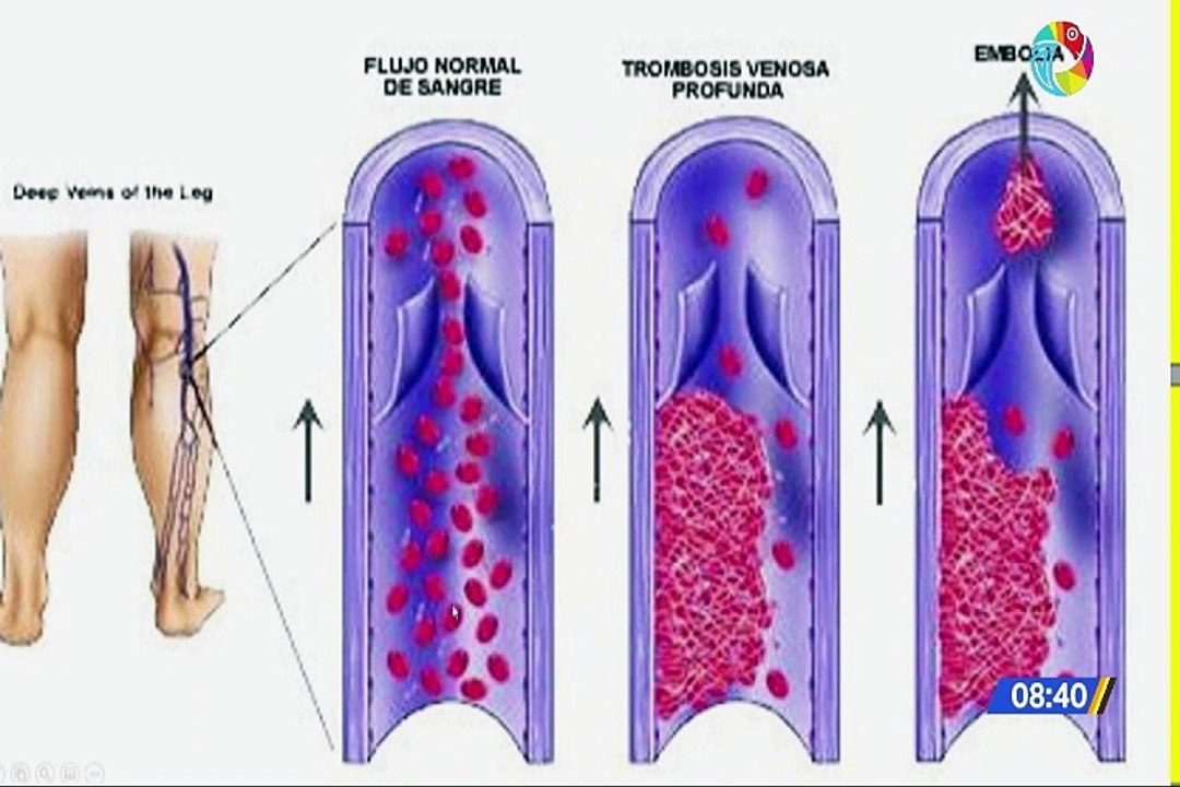 Trombosis ¿que es y como se trata?