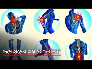 দেশে হাড়ের ক্ষয় রোগ বাড়ছে  | Jagonews24.com