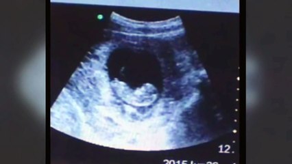 Imágen de demonio mirando a un bebe aparéce en ultrasonido REAL 2016