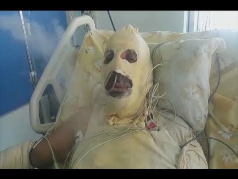 نازح سوري يحرق نفسه في لبنان! - نصري الرز