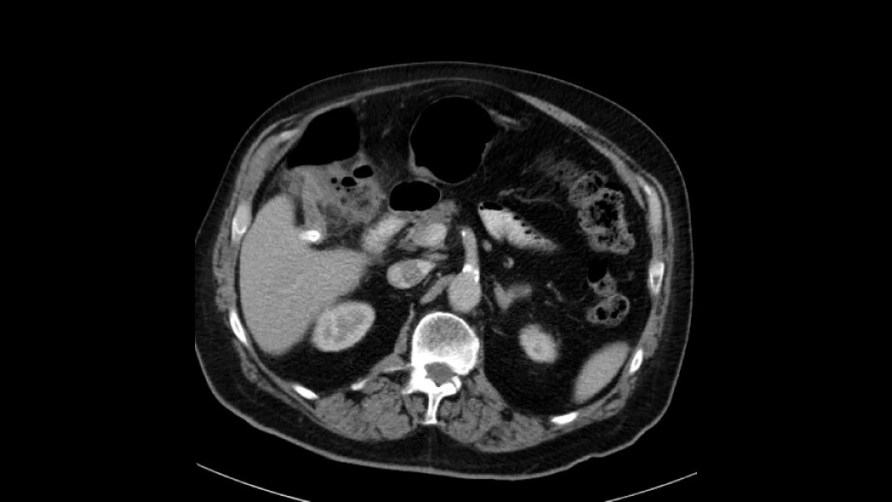 66, 40/68Hz Appendicitis