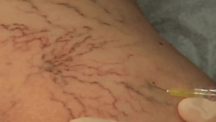 ¿Qué sabes de las arañas vasculares?