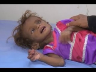 الوضع الإنساني في اليمن اقترب من بدء الهلاك الجماعي