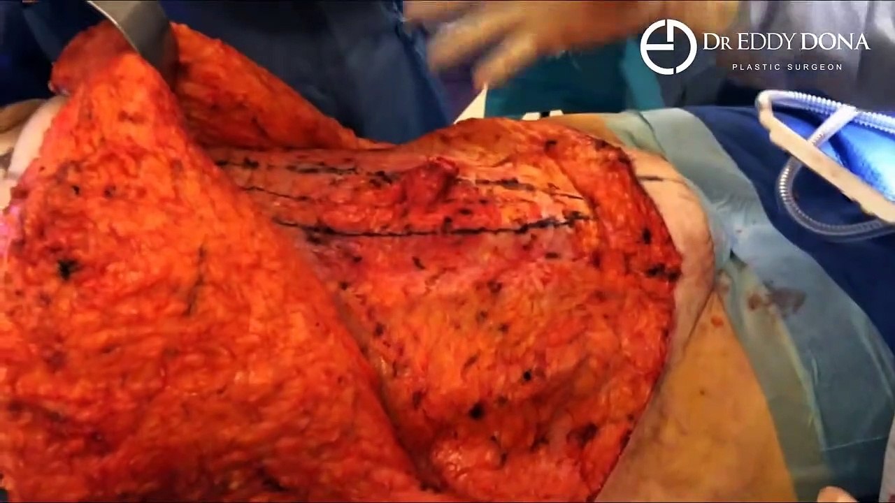 Tummy Tuck – After Significant Weight Loss