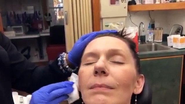 Chemical Peel 1 | Progress And Update On Hyperpigmentation | Chemical Peel Before & After