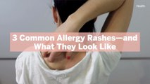 3 Common Allergy Rashes—and What They Look Like