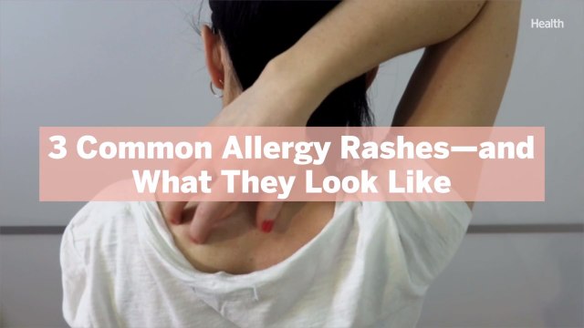 3 Common Allergy Rashes—and What They Look Like