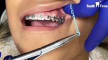 Dental Braces: Power Chains  - Tooth Time New Braunfels Texas
