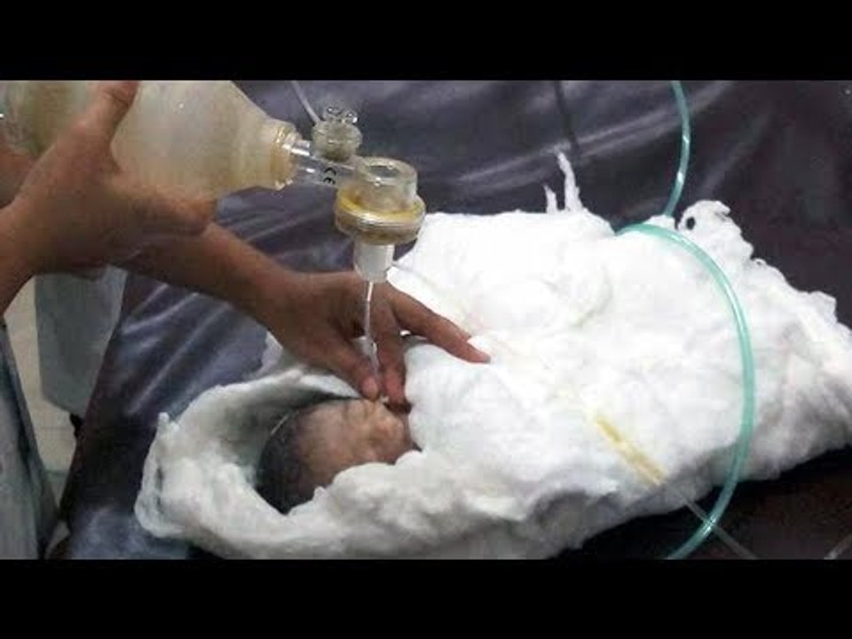 মৃত নবজাতক শিশুটি এখনও বেঁচে আছে | ‘Dead’ Newborn Baby is still Alive