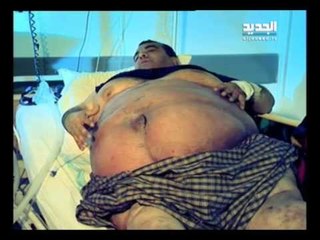 للنشر - الرجل المتورم