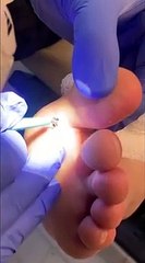 Il a une petite écharde dans le pied... pas si petite que ça