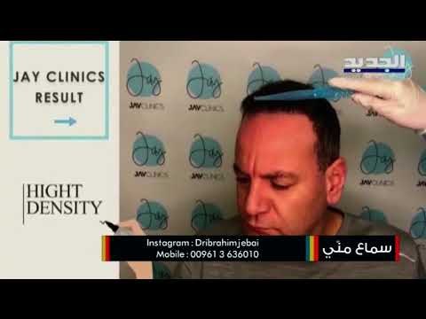 اليكم التقنيات الحديثة الأكثر فعالية في زراعة الشعر