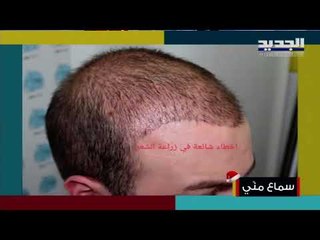 تعرفوا على المقومات التي تضمن خط جبهة طبيعي بعد عمليات زراعة الشعر مع الدكتور إبراهيم جباعي