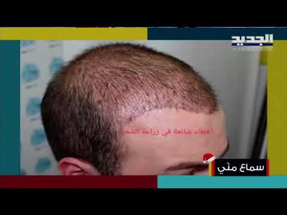 تعرفوا على المقومات التي تضمن خط جبهة طبيعي بعد عمليات زراعة الشعر مع الدكتور إبراهيم جباعي
