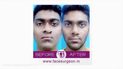 How Much Does A Nose Job Cost? (Rhinoplasty) - Dr. Sunil Richardson