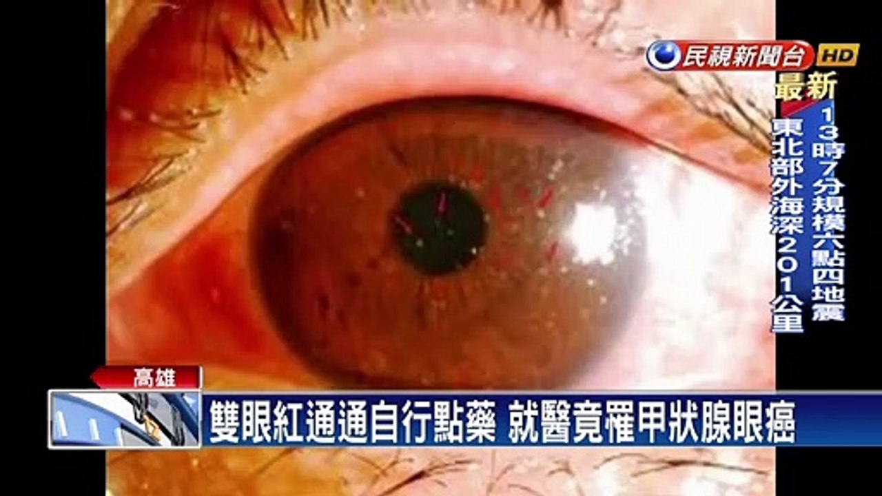 雙眼紅通通自行點藥 就醫竟罹甲狀腺眼癌