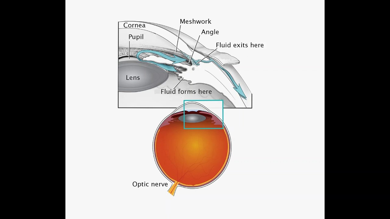 52Hz Arthritis, Cataract