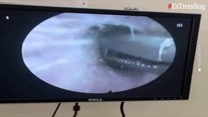 Video: médico extrae una mariposa viva que había quedado atrapada en el oído de un hombre