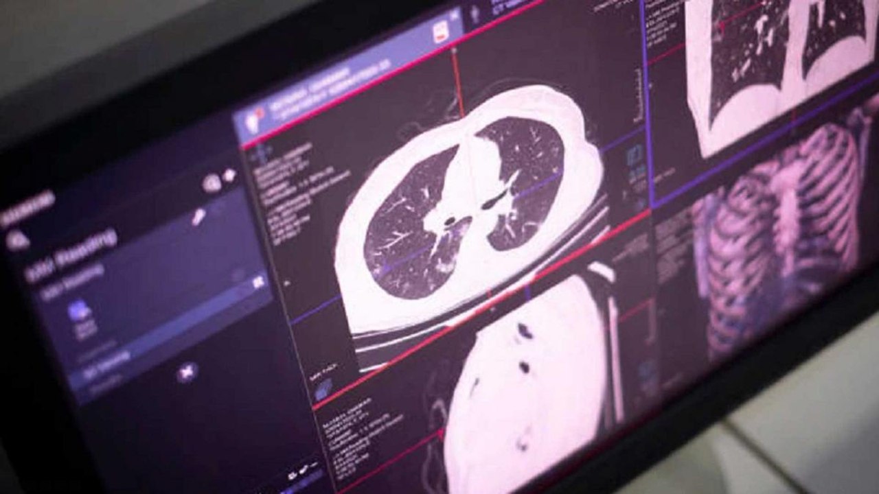 What is CT Scan and how it could lead to cancer?