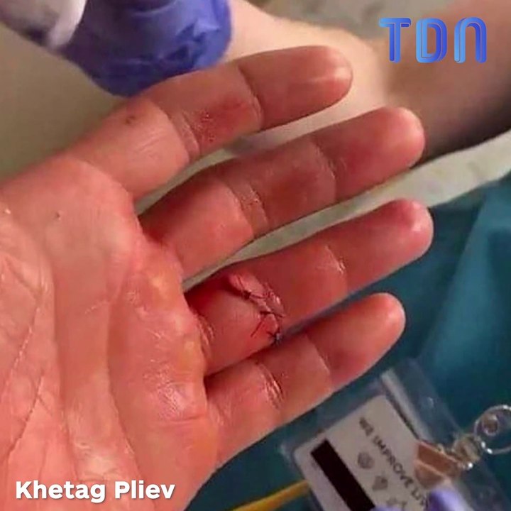Khetag Pliev perd son doigt en plein combat de MMA !