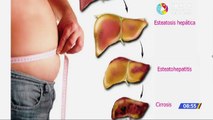 Hígado graso causas y consecuencias